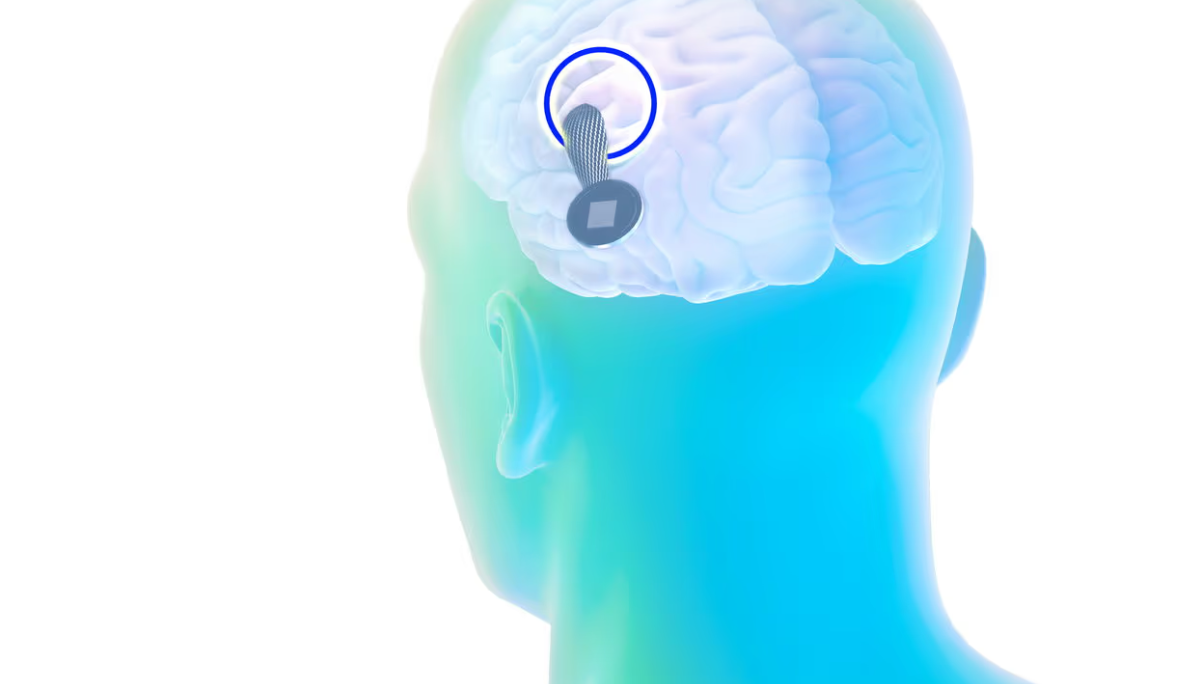 En enero de 2024, Neuralink, empresa de neurotecnología fundada por Elon Musk, realizó el primer implante de un chip cerebral en un ser humano.