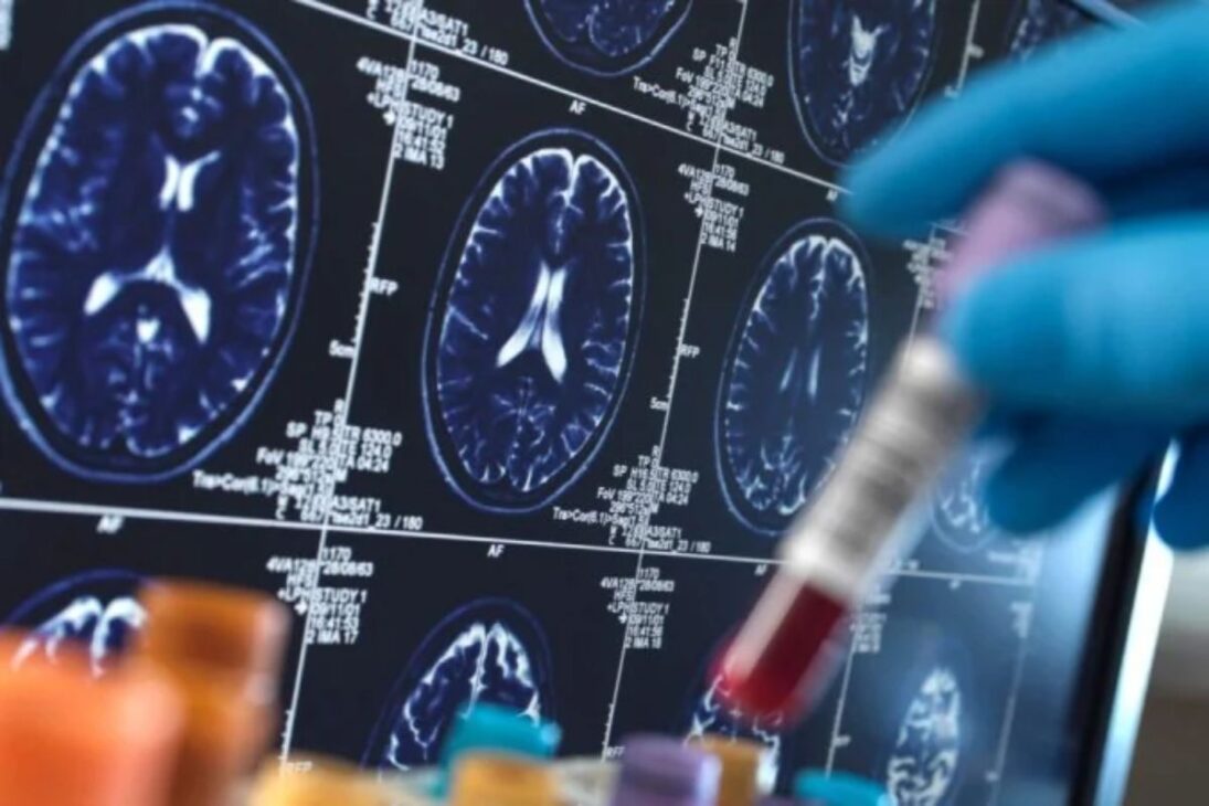 Universidad de Cambridge crea IA que prevé riesgo de Alzheimer con alta precisión y ayuda a identificar tratamientos eficaces