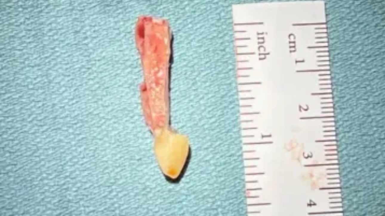 Hombre vuelve a ver tras 20 años de ceguera con rara cirugía que usa un diente para sostener lente en el ojo. Técnica inédita en Canadá.