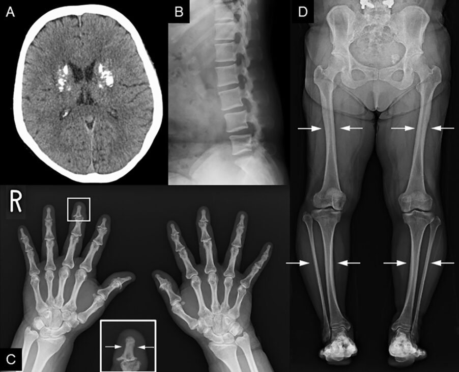 enfermedad de Caffey
