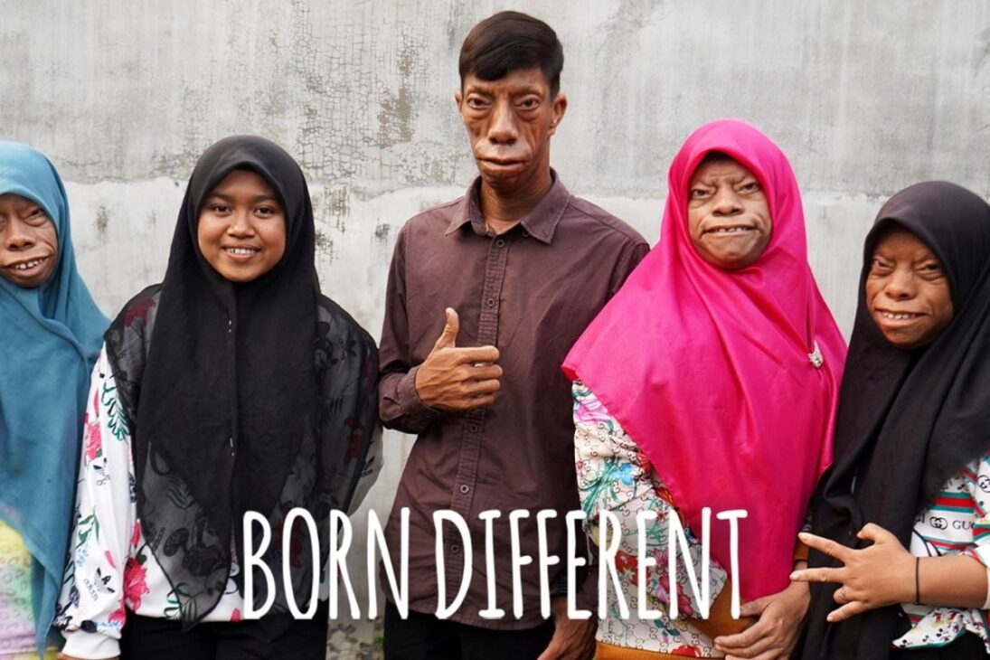 Historia De Una Familia Con Rostros Que Cambian De Forma Que Enfrenta Bullying, Vive Con Rara Síndrome Genética, Desafía El Prejuicio Y Transforman Dolor En Unión Y Esperanza.