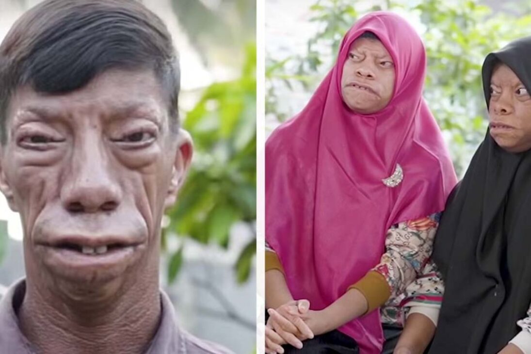 Historia De Una Familia Con Rostros Que Cambian De Forma Que Enfrenta Bullying, Vive Con Rara Síndrome Genética, Desafía El Prejuicio Y Transforman Dolor En Unión Y Esperanza.