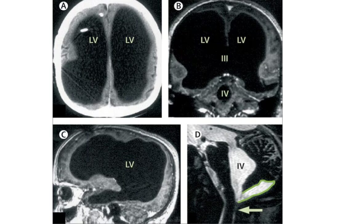 Entiende Cómo Un Caso De Hidrocefalia Reveló Un Cerebro Drásticamente Comprimido, Pero Con Rutina Funcional, Y Por Qué Esto Reabre El Debate Sobre Conciencia Y Adaptación Humana En Situaciones Límite.